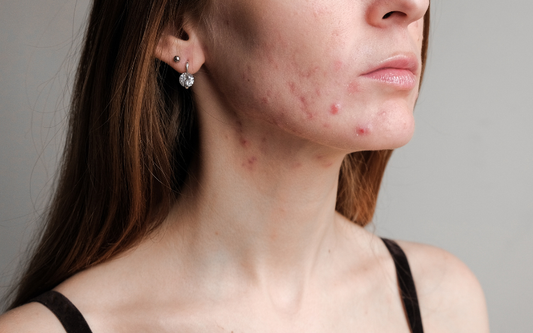 Acne Awareness Month: The Pro’s Guide to Dealing with Breakouts, Blemishes & Congested Skin